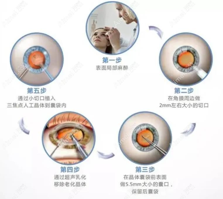 什么是人工晶体近视手术 什么是人工晶体近视手术