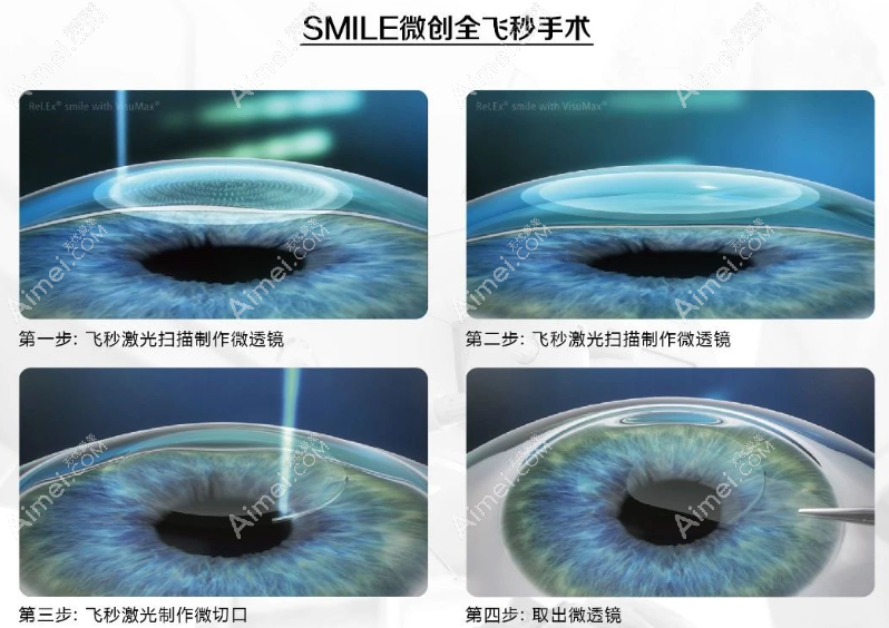 全飞秒手术近视散光多少度 全飞秒手术近视散光多少度