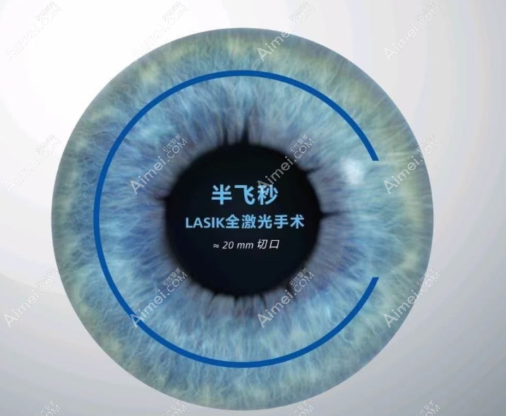 近视眼700度手术半飞秒价格11000元起 近视眼700度手术半飞秒价格11000元起