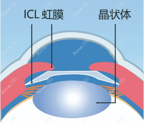 重庆icl晶体手术 重庆icl晶体手术