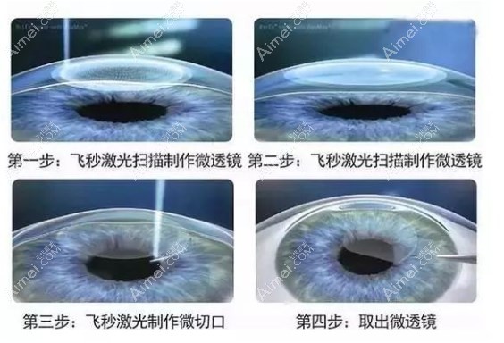 全飞秒激光手术的利弊 全飞秒激光手术的利弊