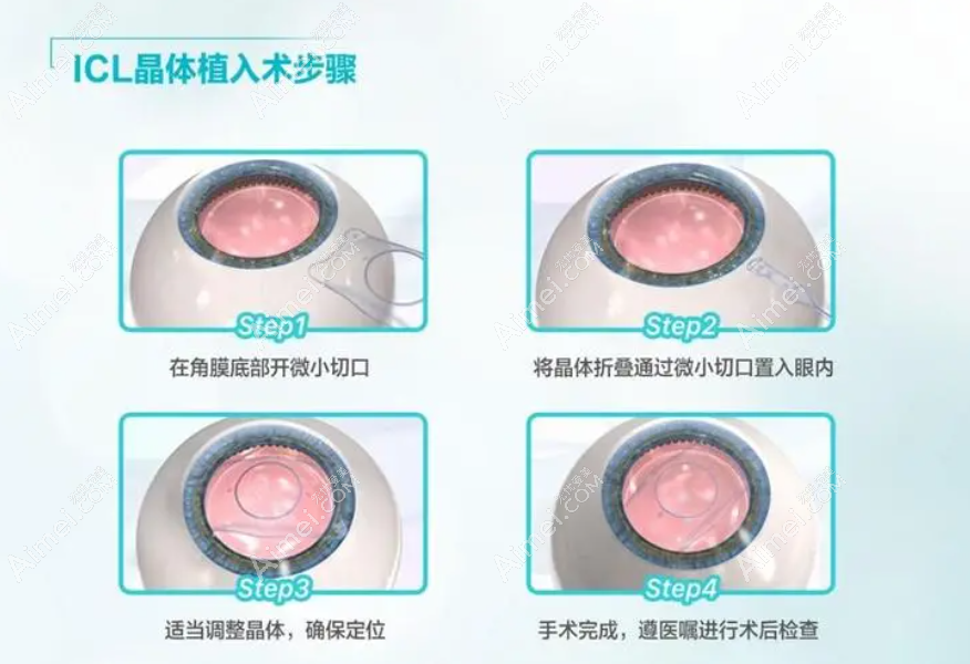 icl晶体植入近视眼手术过程和步骤 icl晶体植入近视眼手术过程和步骤