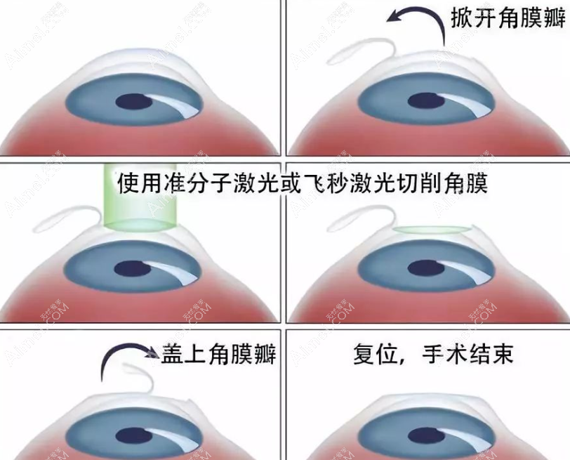 散光能做激光近视手术吗 散光能做激光近视手术吗