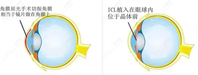重庆晶体植入手术多少钱?重庆近视植入icl晶体价格26500元起