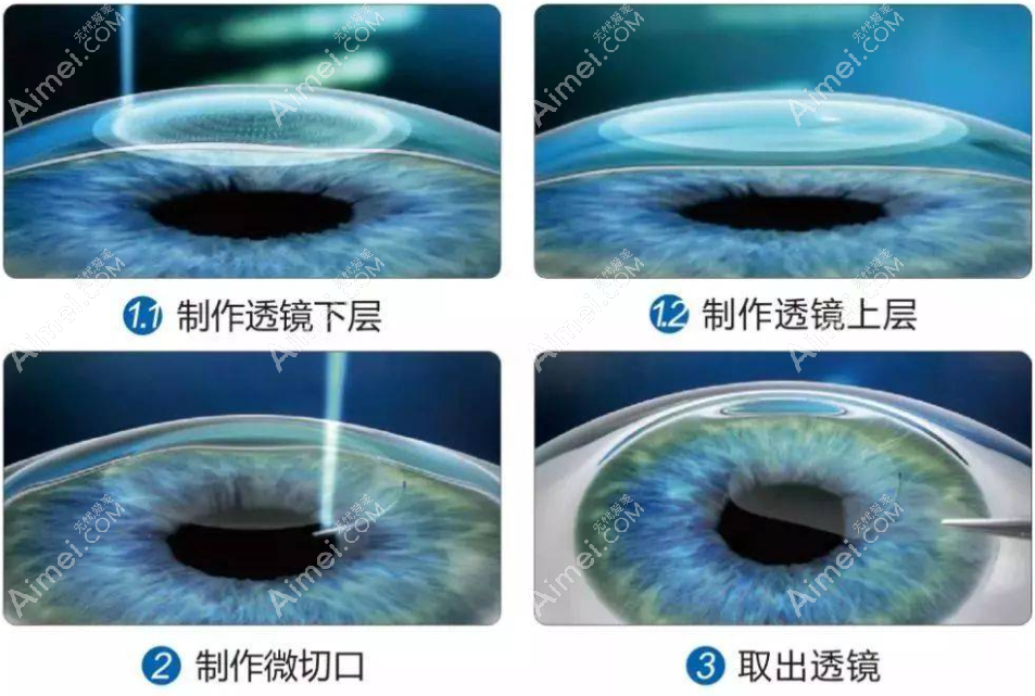 半飞秒近视散光范围 爱美网 半飞秒近视散光范围 爱美网