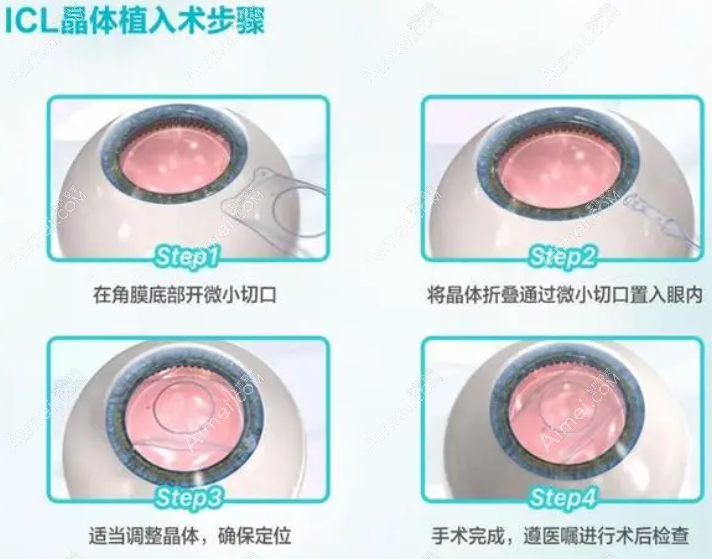 散光做近视眼晶体植入价格 散光做近视眼晶体植入价格