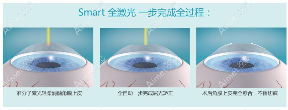 smart全激光手术的优缺点 smart全激光手术的优缺点