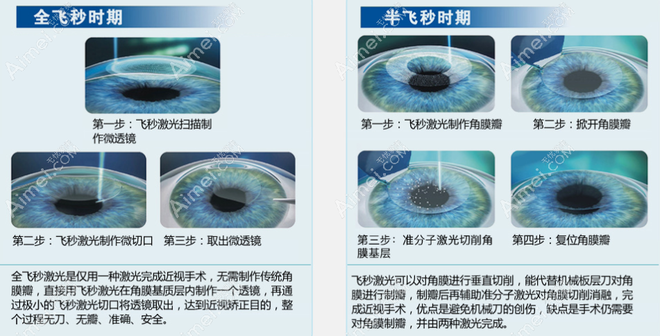 全飞秒和半飞秒手术方式对比 全飞秒和半飞秒手术方式对比