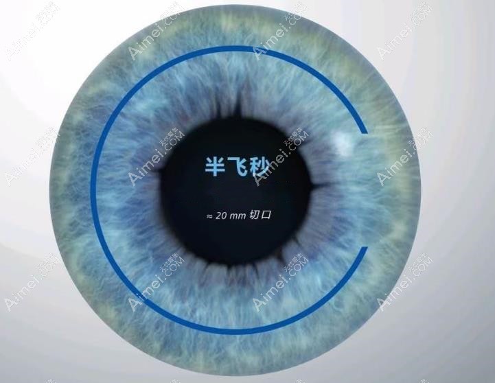 半飞秒手术优点和缺点解析 半飞秒手术优点和缺点解析