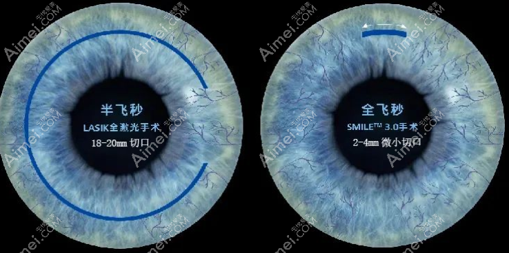 飞秒激光近视手术要多少钱?国内全飞秒比半飞秒价格贵5000多