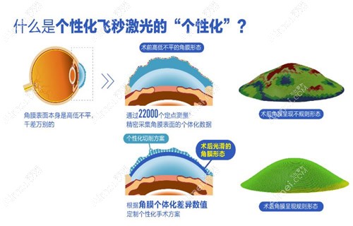个性化半飞秒和普通半飞秒区别大,价格差2-4k,角膜切削不同