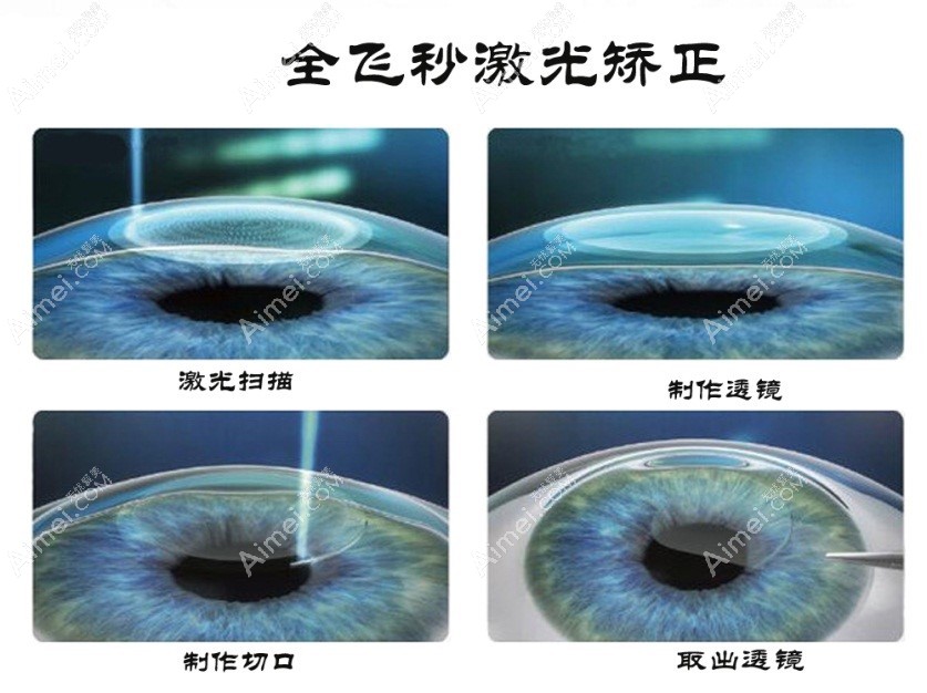 昆明眼科医院全飞秒激光近视眼手术 昆明眼科医院全飞秒激光近视眼手术