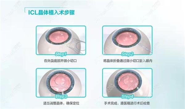 昆明眼科医院ICL人工晶体植入手术 昆明眼科医院ICL人工晶体植入手术