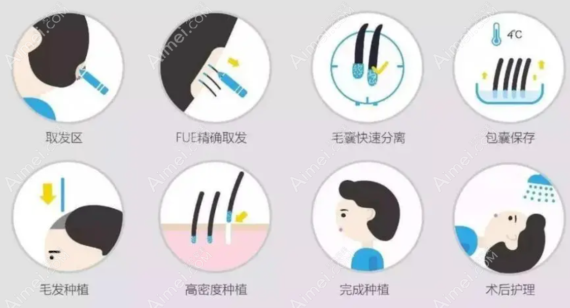 保定熙朵头发移植过程 保定熙朵头发移植过程