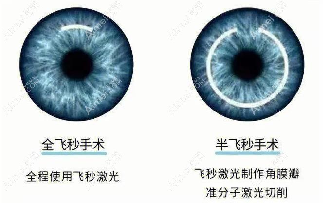 南宁飞秒激光手术价格表 南宁飞秒激光手术价格表