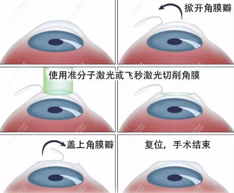 成人激光近视手术费用8800元起 成人激光近视手术费用8800元起