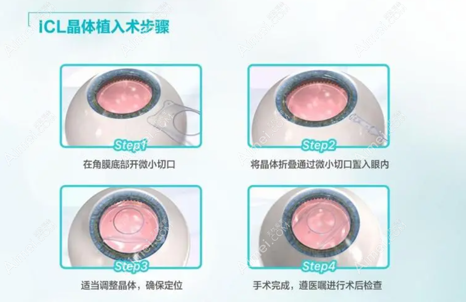 晶体置换跟晶体植入区别 晶体置换跟晶体植入区别