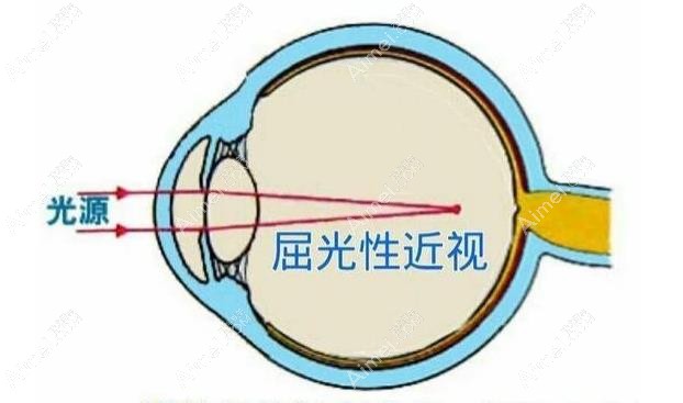 屈光性近视 屈光性近视