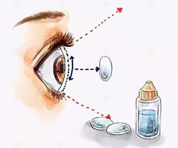 眼睛近视矫正多少钱?儿童OK镜矫正费用4000+成人激光手术10000+