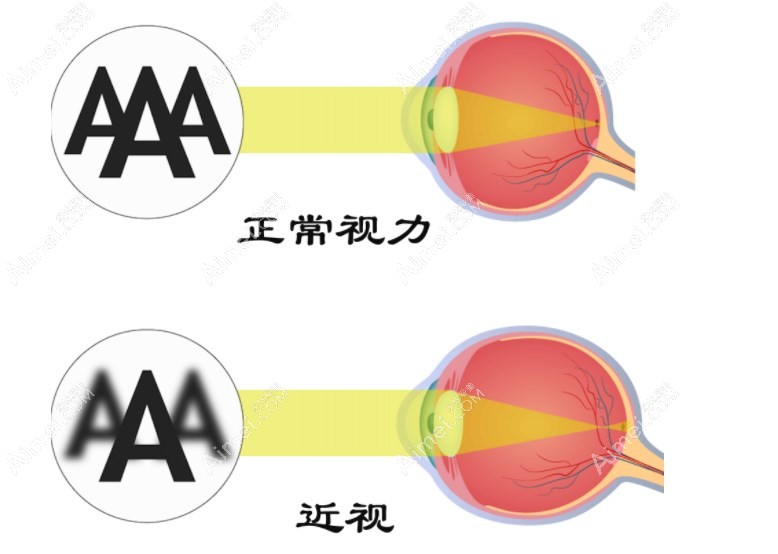 重庆高度近视手术好的眼科医院推荐重庆佰视佳眼科 重庆高度近视手术好的眼科医院推荐重庆佰视佳眼科