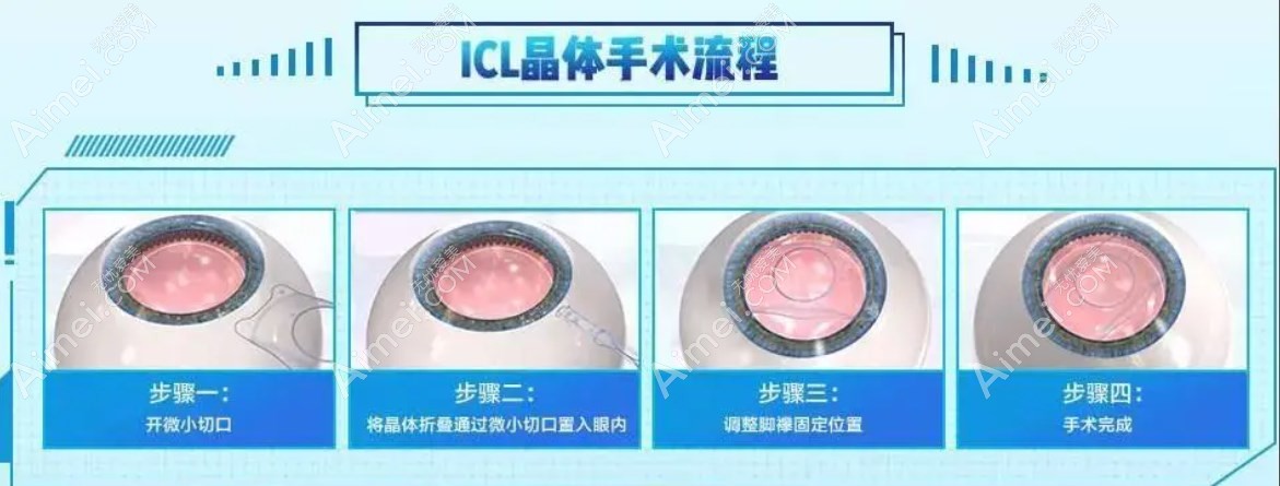 icl晶体植入流程 icl晶体植入流程
