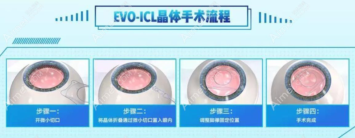 icl晶体移位二次手术需要另收费吗 icl晶体移位二次手术需要另收费吗