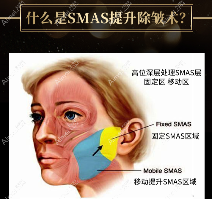 广州中家医黄广香医生smas面部提升怎么样 广州中家医黄广香医生smas面部提升怎么样