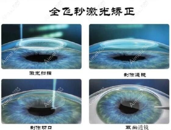 全飞秒近视眼手术治疗过程m.dlren.com 全飞秒近视眼手术治疗过程m.dlren.com