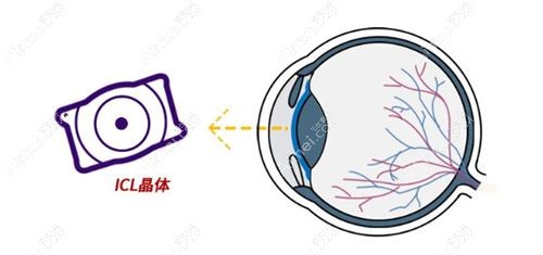 icl第六代晶体国内能做吗?icl-v6晶体国内没上市,现可做icl五代