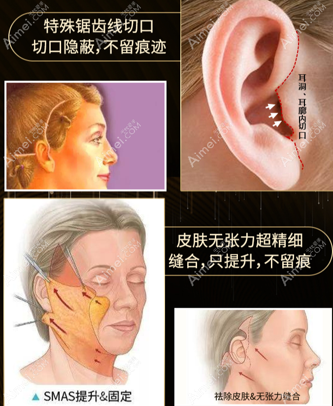 广州中家医朱云医生smas面部提升怎么样 广州中家医朱云医生smas面部提升怎么样