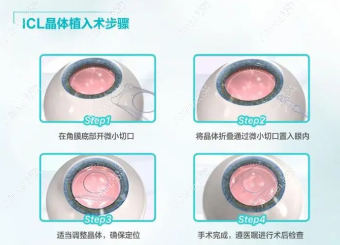 佰视佳眼科icl晶体植入近视手术价格 佰视佳眼科icl晶体植入近视手术价格