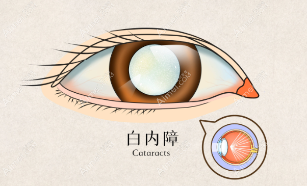 长沙博视眼科医院白内障手术价格 长沙博视眼科医院白内障手术价格