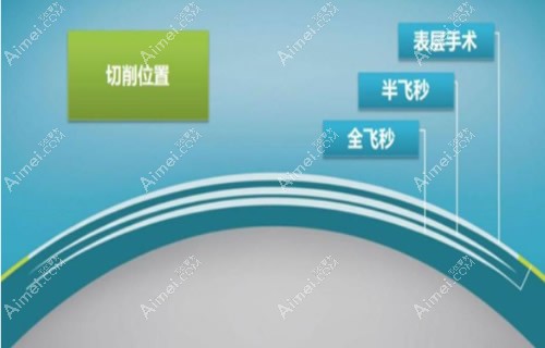 近视眼表层手术多少钱?表层激光近视手术价格8500,附优缺点