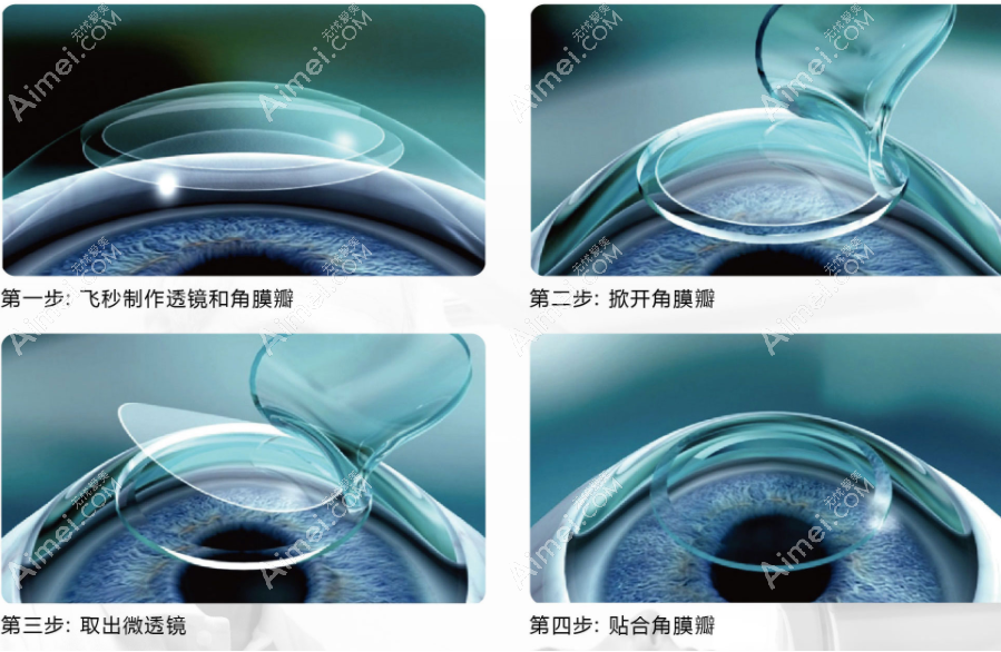 全飞秒手术的利弊分析:看全飞秒手术如何避免危害和后遗