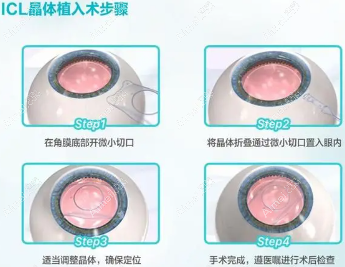 高度近视做晶体植入矫正怎么样 dlren.com 高度近视做晶体植入矫正怎么样 dlren.com