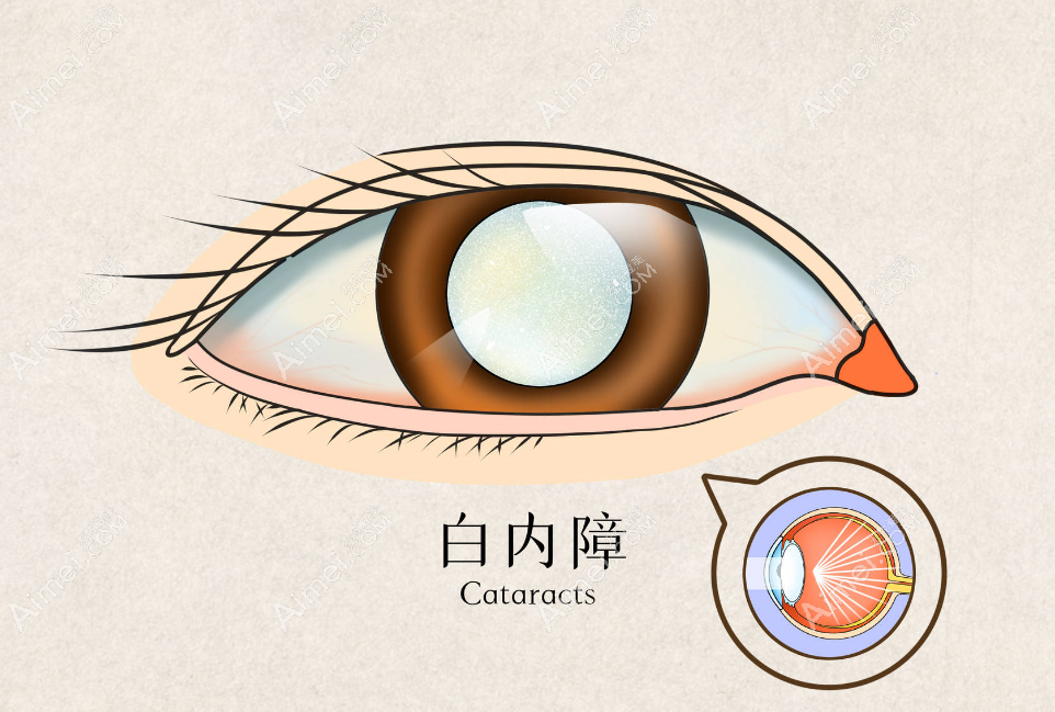 白内障人工晶体价格大概多少钱 白内障人工晶体价格大概多少钱