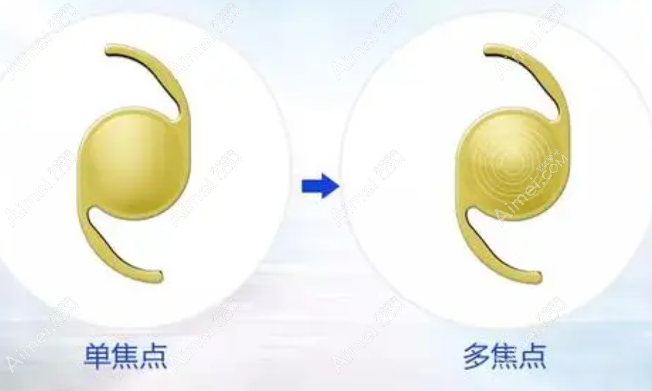白内障人工晶体2023价目表大全 白内障人工晶体2023价目表大全