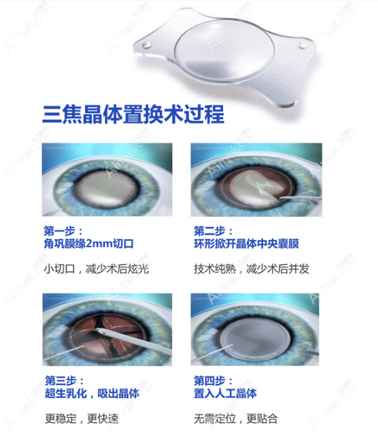德国蔡司双焦点人工晶体价格 德国蔡司双焦点人工晶体价格