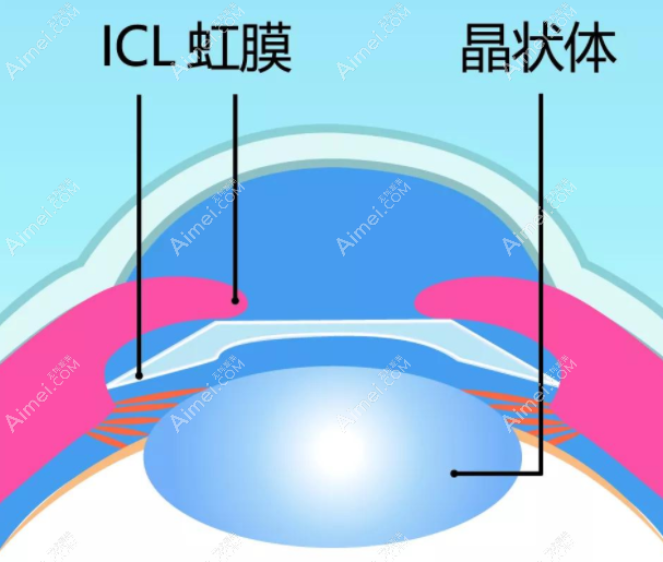 icl晶体植入手术过程dlren.com icl晶体植入手术过程dlren.com
