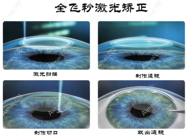 全飞秒激光矫正手术过程示意 全飞秒激光矫正手术过程示意
