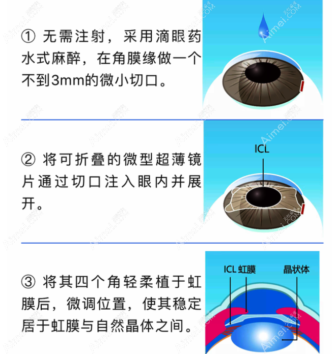 ICL晶体植入手术怎么做 ICL晶体植入手术怎么做