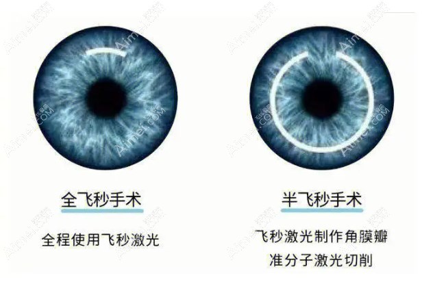 惠州飞秒手术价格 惠州飞秒手术价格