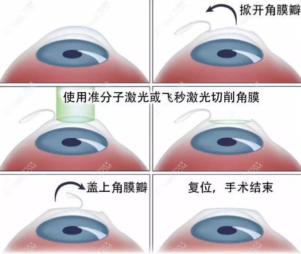 半飞秒激光手术图解dlren.com 半飞秒激光手术图解dlren.com