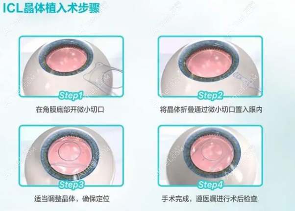 晶体植入步骤 晶体植入步骤