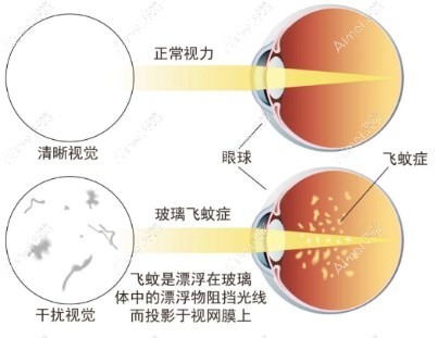 飞蚊症