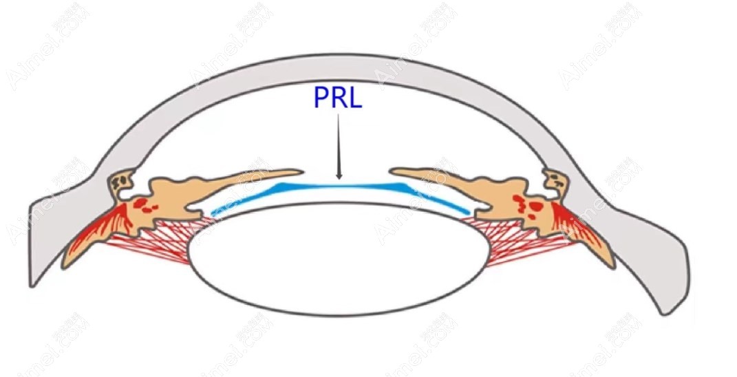 PRL晶体植入被禁停产不可信,解答为什么prl晶体做的人少了