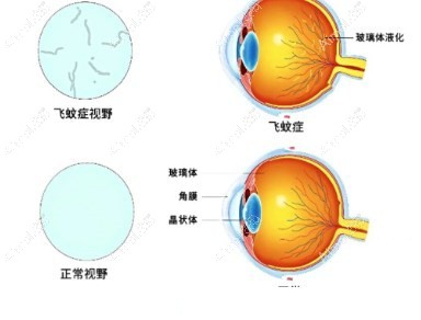 飞蚊症原理