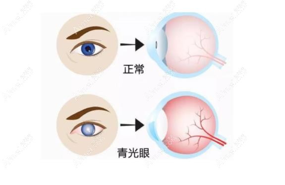青光眼激光手术价格是多少?激光小梁切除术1k+/虹膜切除术2k+