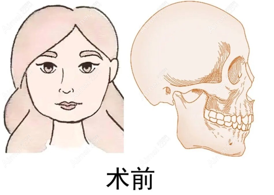 肖林磨骨实例 肖林磨骨实例