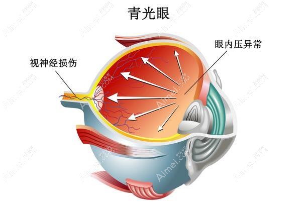 青光眼周边虹膜切除术价格 青光眼周边虹膜切除术价格